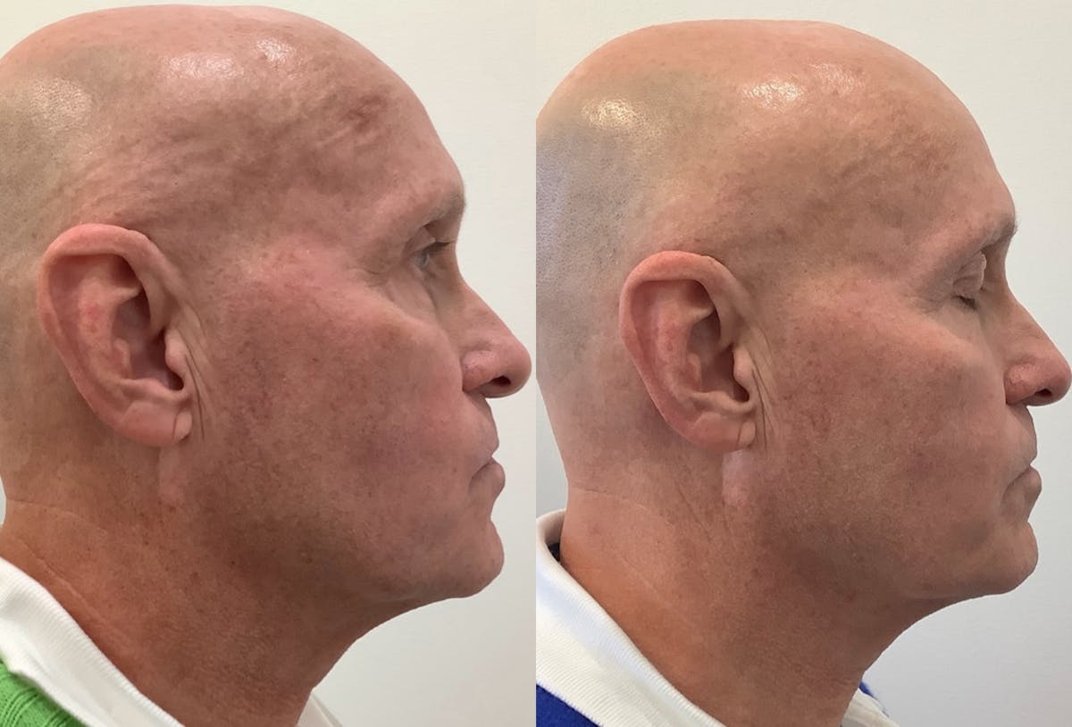 BBL Laser Before & After Gallery - Patient 320692 - Image 2