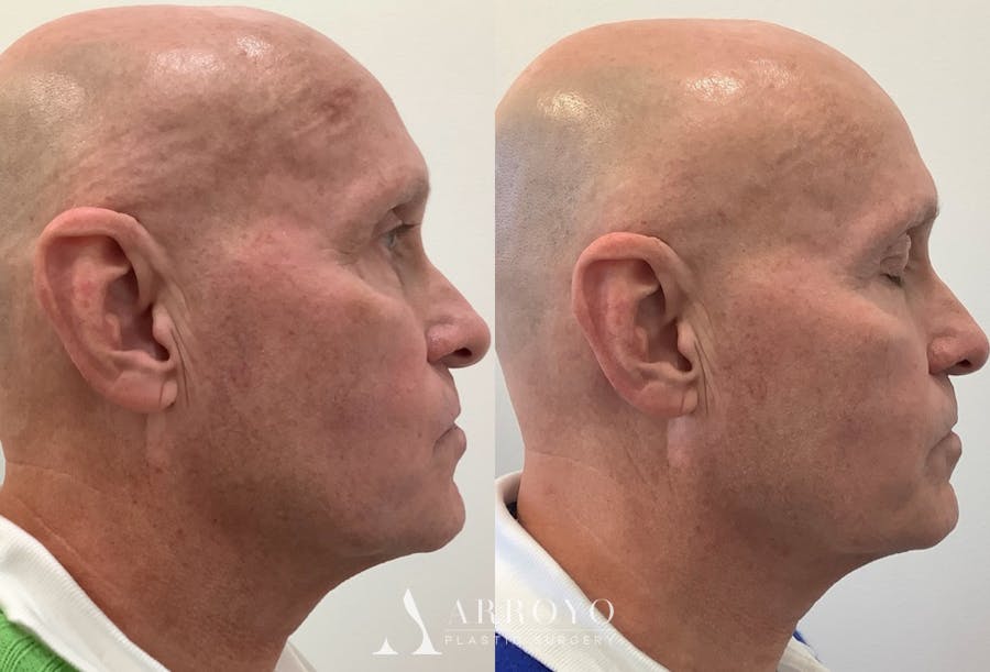 Morpheus8 Before & After Gallery - Patient 172327 - Image 1