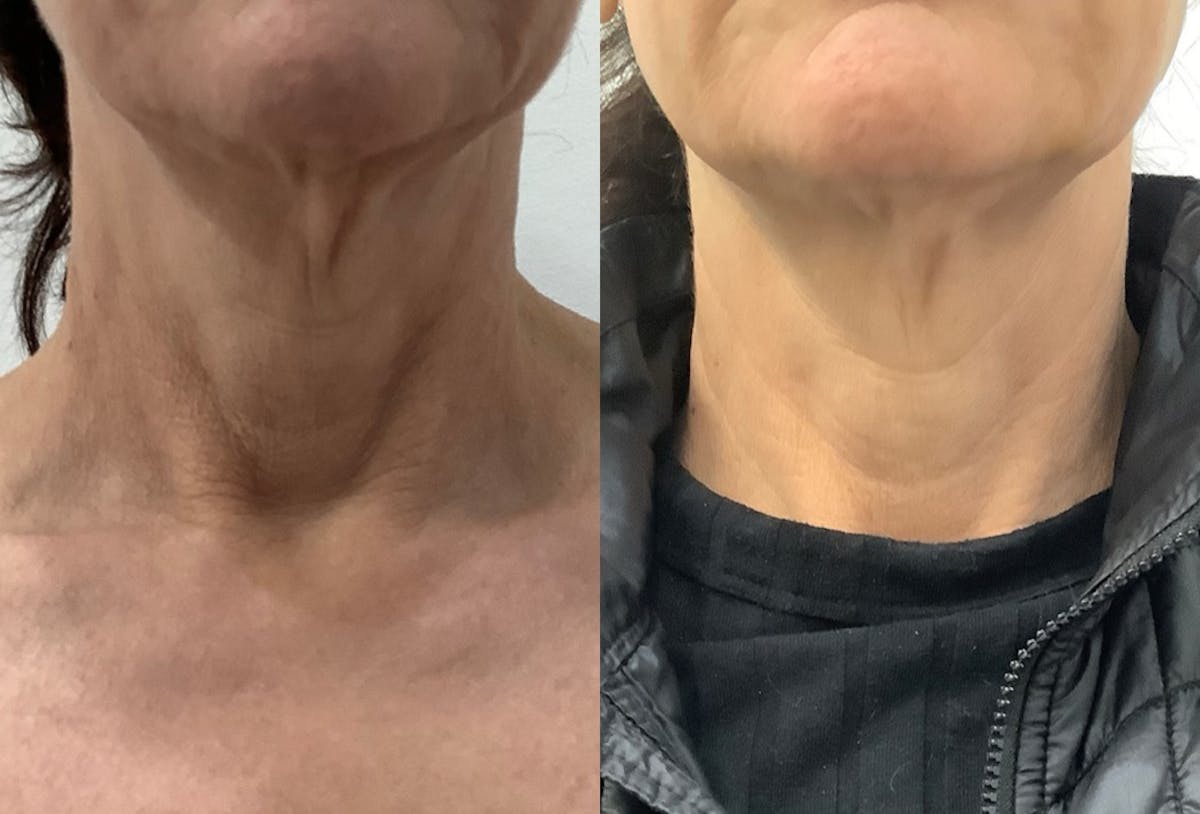 Halo Laser Before & After Gallery - Patient 395274 - Image 1
