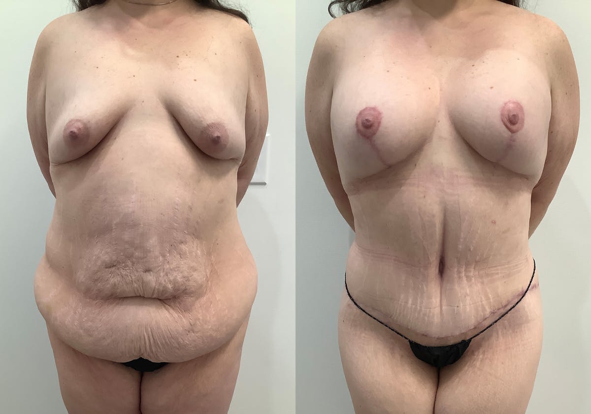 Liposuction Before & After Gallery - Patient 408835 - Image 1