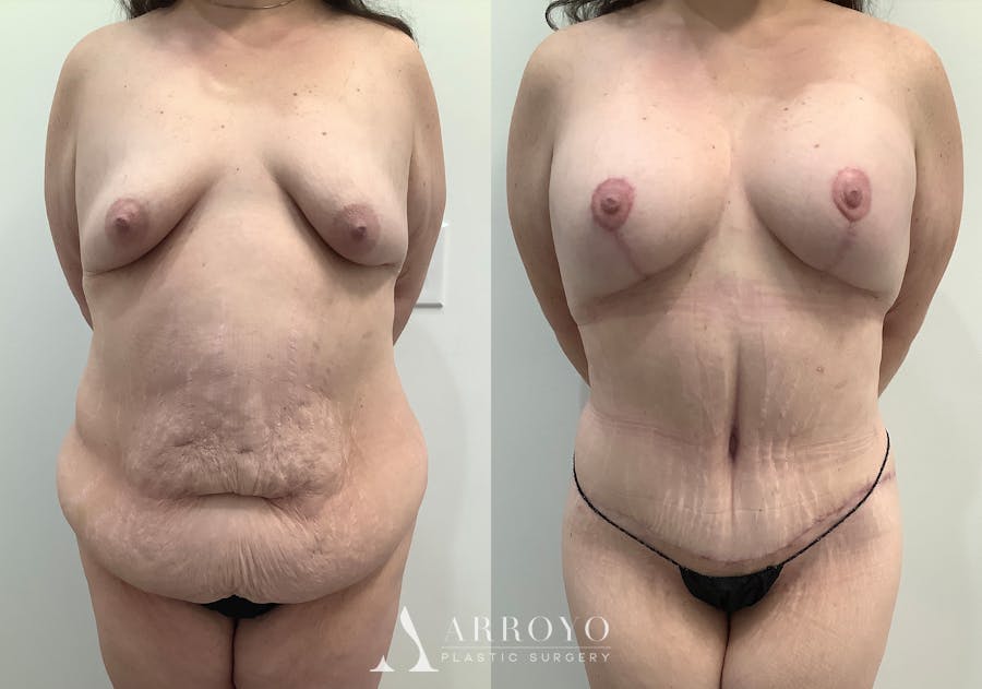 Tummy Tuck Before & After Gallery - Patient 242816 - Image 1