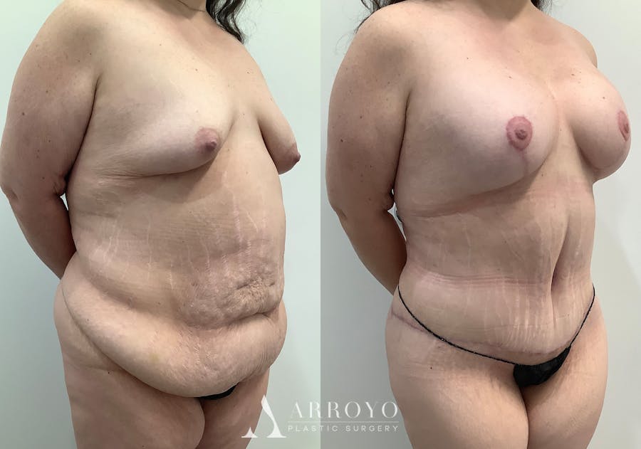 Tummy Tuck Before & After Gallery - Patient 242816 - Image 2