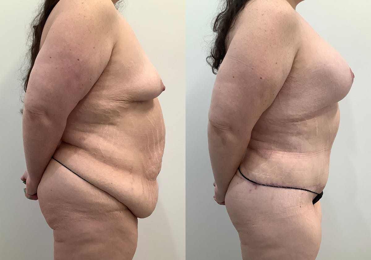 Liposuction Before & After Gallery - Patient 408835 - Image 3