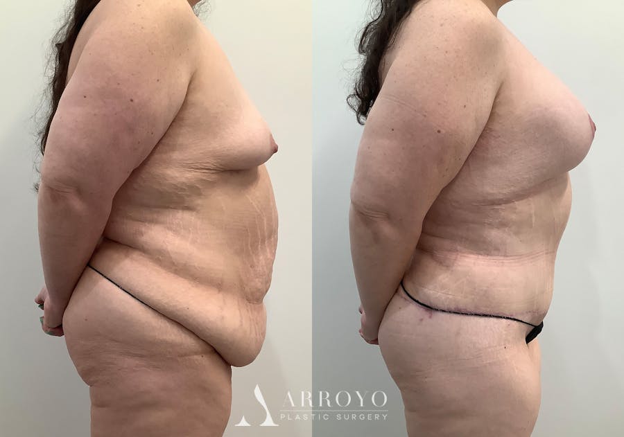 Tummy Tuck Before & After Gallery - Patient 242816 - Image 3