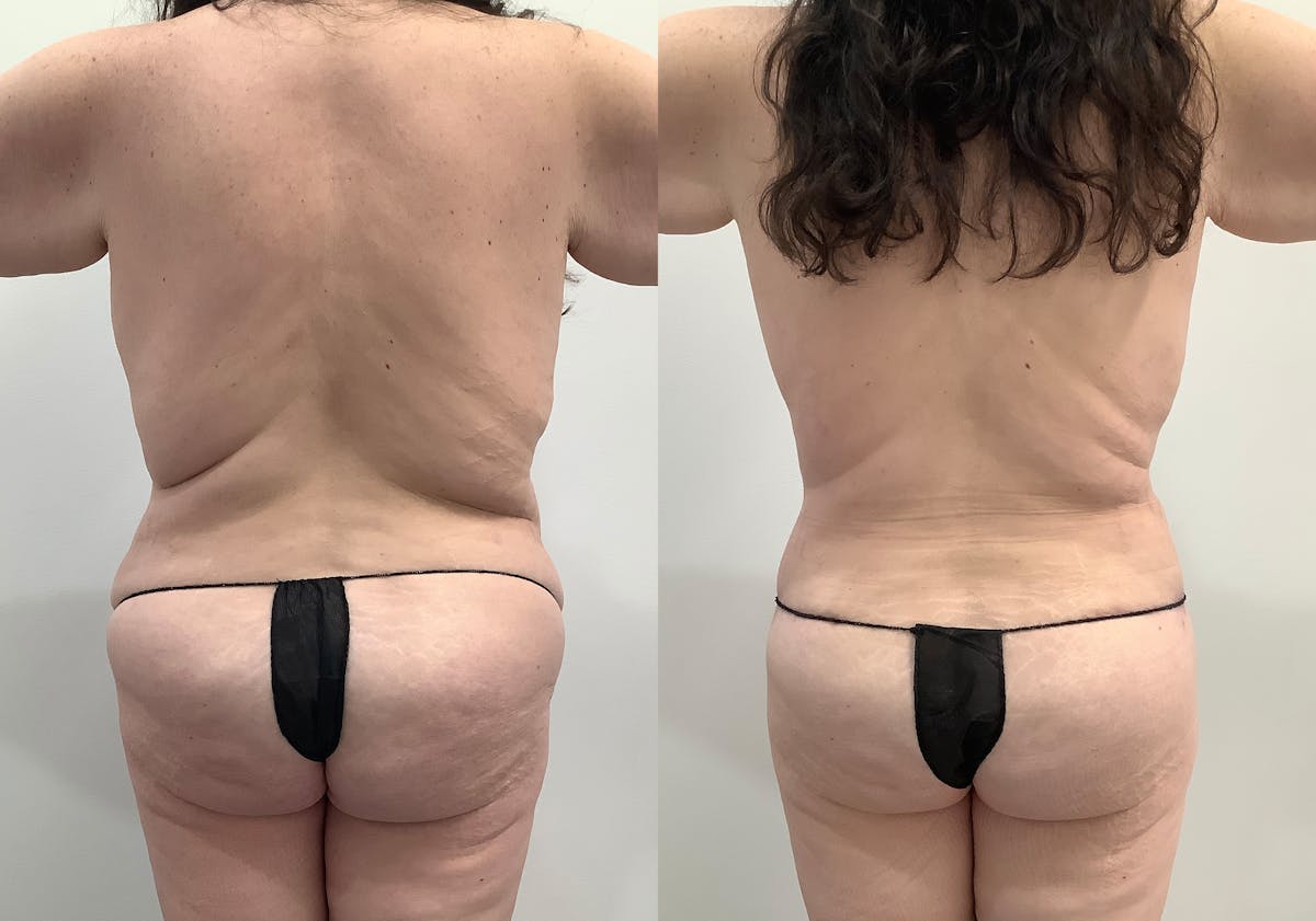Liposuction Before & After Gallery - Patient 408835 - Image 4