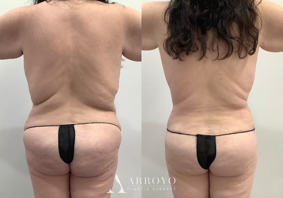 Tummy Tuck Before & After Gallery - Patient 242816 - Image 4