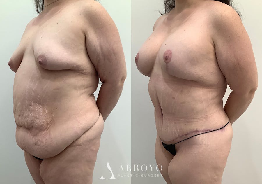 Tummy Tuck Before & After Gallery - Patient 242816 - Image 5