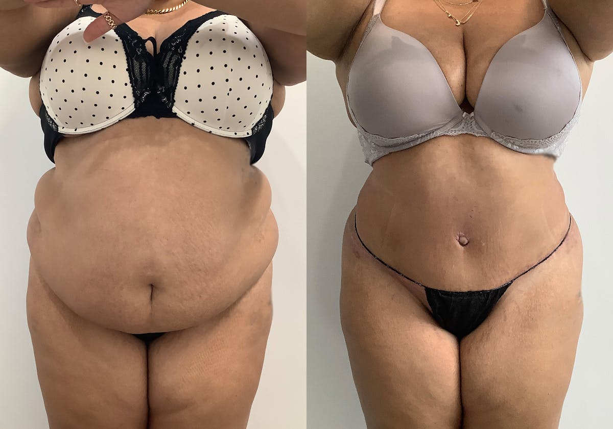 Liposuction Before & After Gallery - Patient 129991 - Image 1