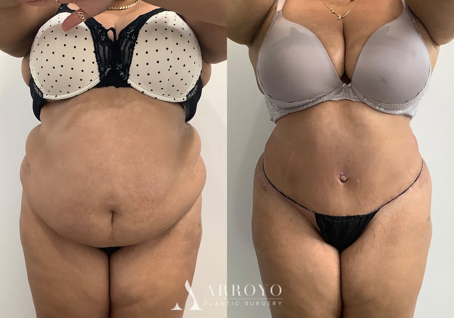 Tummy Tuck Before & After Gallery - Patient 111663 - Image 1