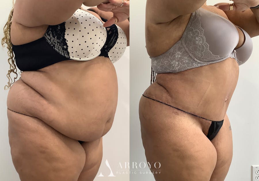 Tummy Tuck Before & After Gallery - Patient 111663 - Image 2
