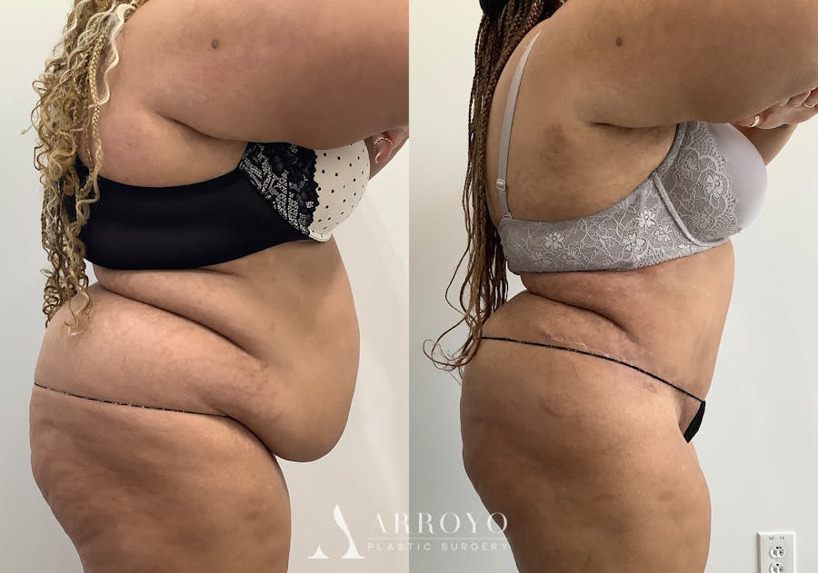 Tummy Tuck Before & After Gallery - Patient 111663 - Image 3