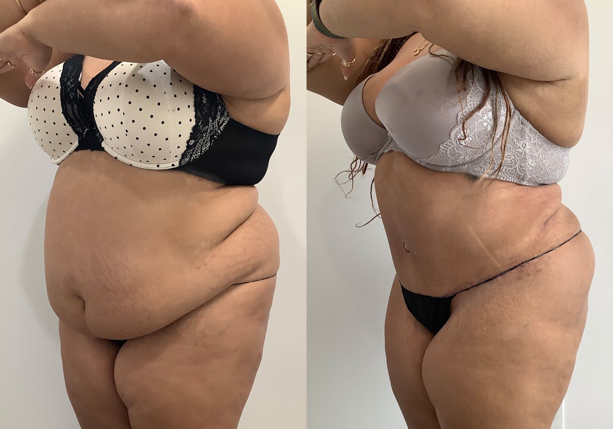 Liposuction Before & After Gallery - Patient 129991 - Image 4