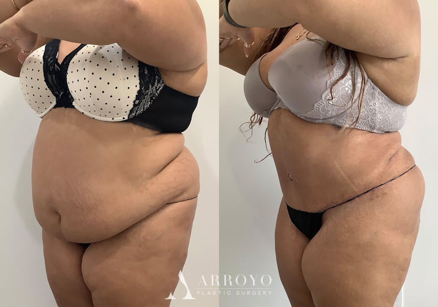 Tummy Tuck Before & After Gallery - Patient 111663 - Image 4