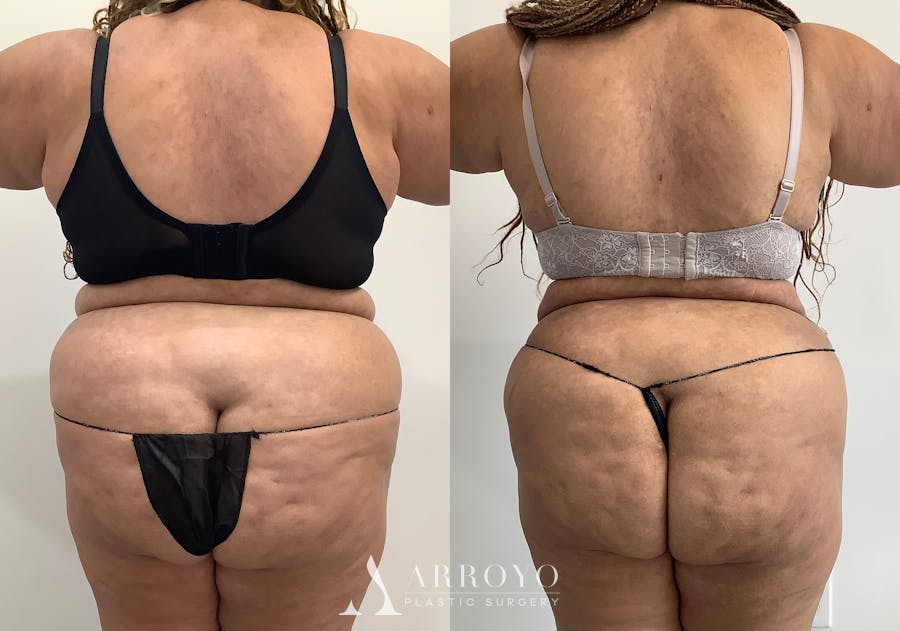 Tummy Tuck Before & After Gallery - Patient 111663 - Image 5