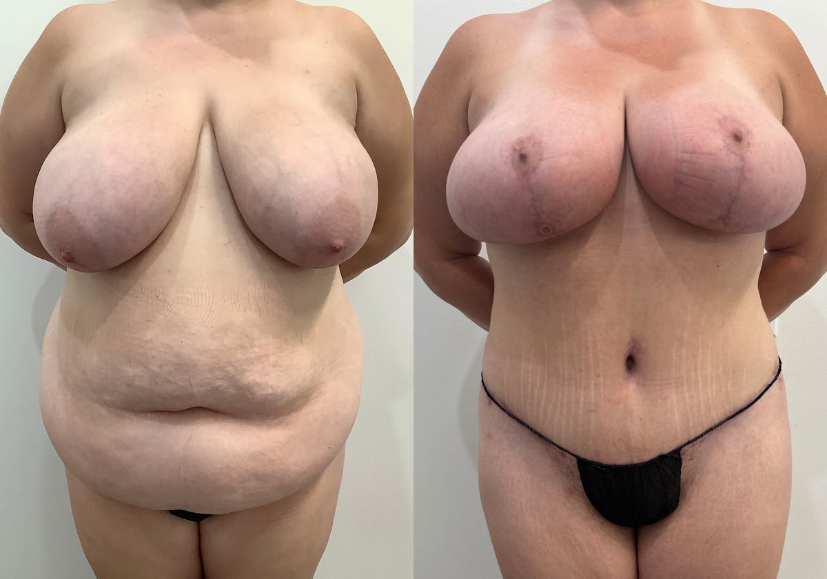 Liposuction Before & After Gallery - Patient 344824 - Image 1