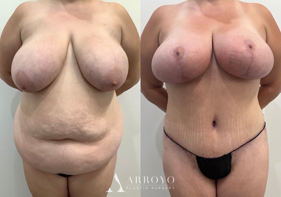 Tummy Tuck Before & After Gallery - Patient 144728 - Image 1