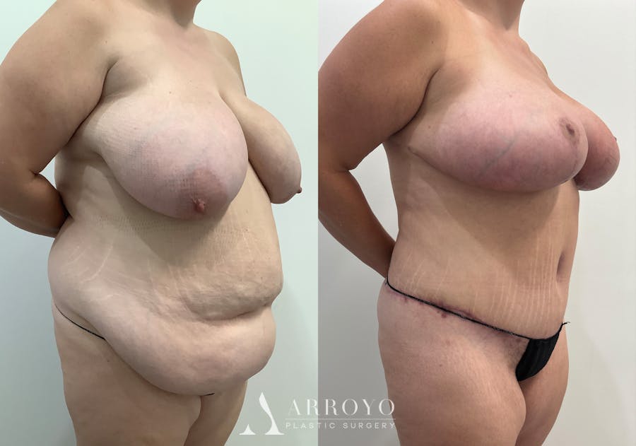 Tummy Tuck Before & After Gallery - Patient 144728 - Image 2
