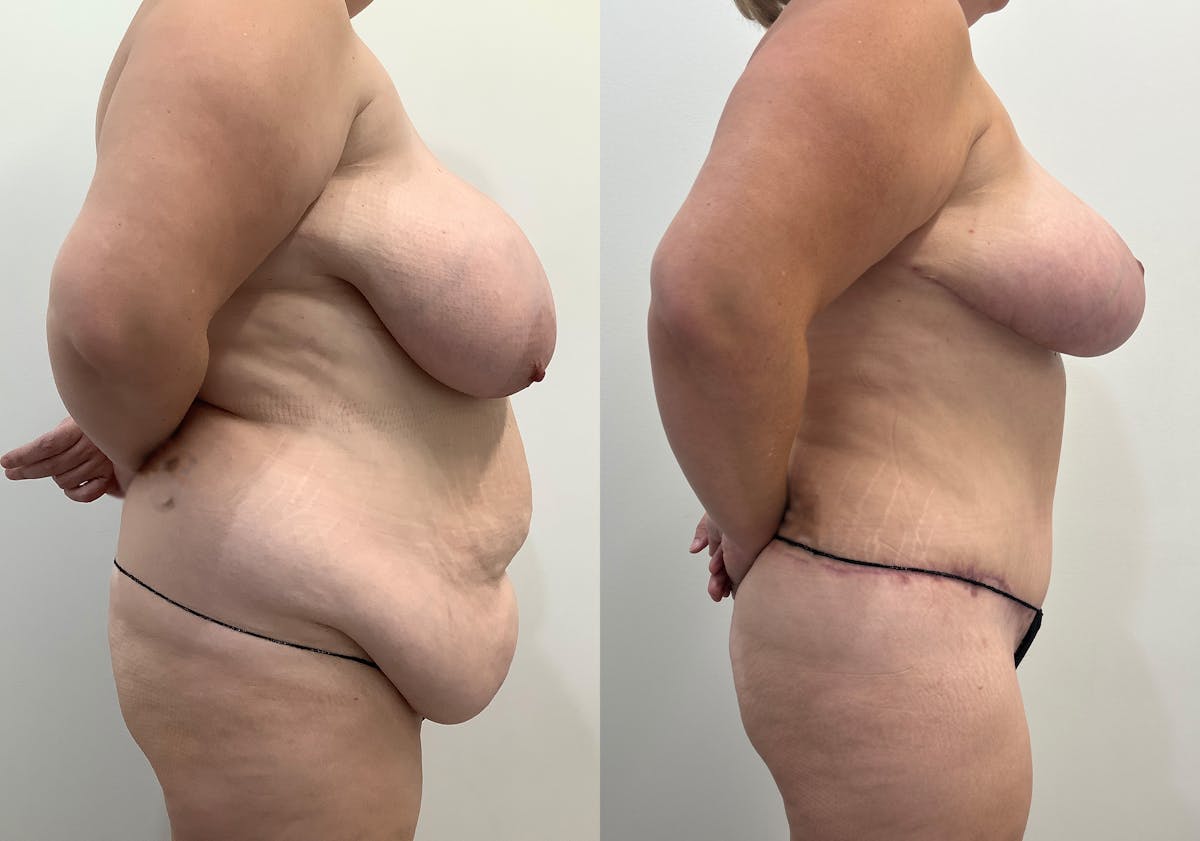 Liposuction Before & After Gallery - Patient 344824 - Image 3