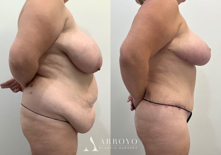 Tummy Tuck Before & After Gallery - Patient 144728 - Image 3