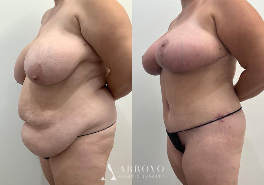Tummy Tuck Before & After Gallery - Patient 144728 - Image 4