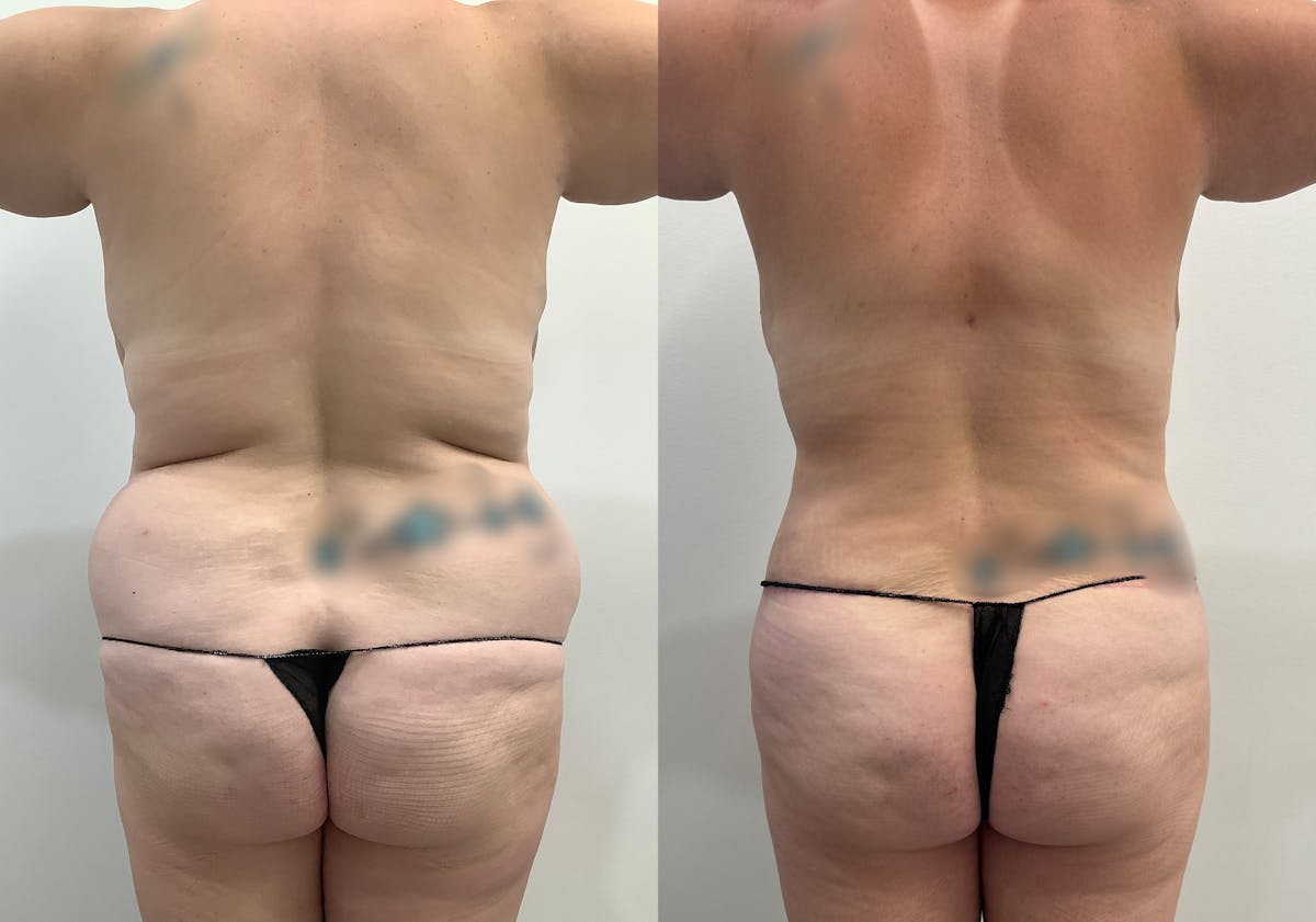 Liposuction Before & After Gallery - Patient 344824 - Image 5