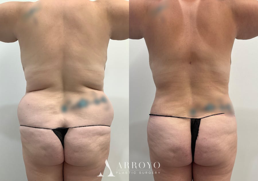 Tummy Tuck Before & After Gallery - Patient 144728 - Image 5