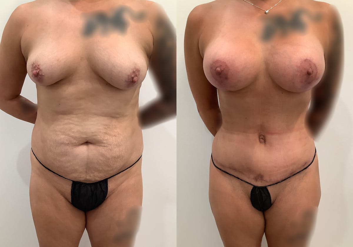 Breast Augmentation with Lift Before & After Gallery - Patient 354953 - Image 1