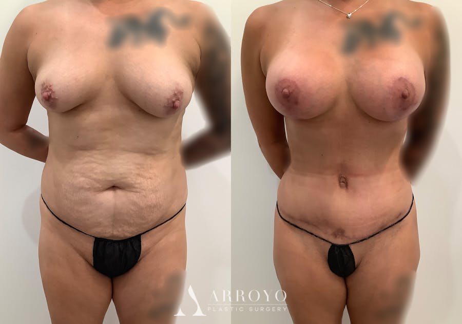 Tummy Tuck Before & After Gallery - Patient 246944 - Image 1