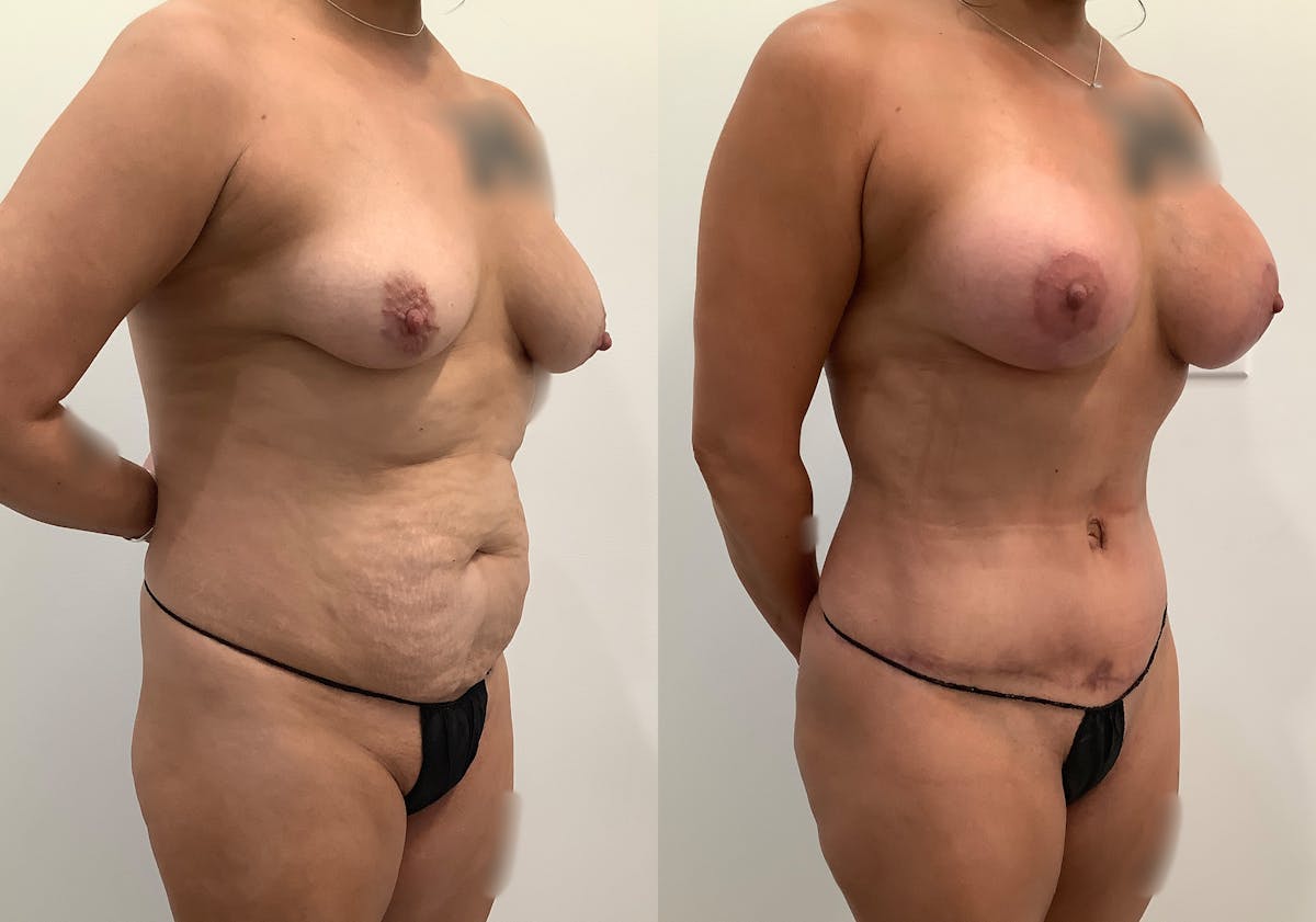 Breast Augmentation with Lift Before & After Gallery - Patient 354953 - Image 2
