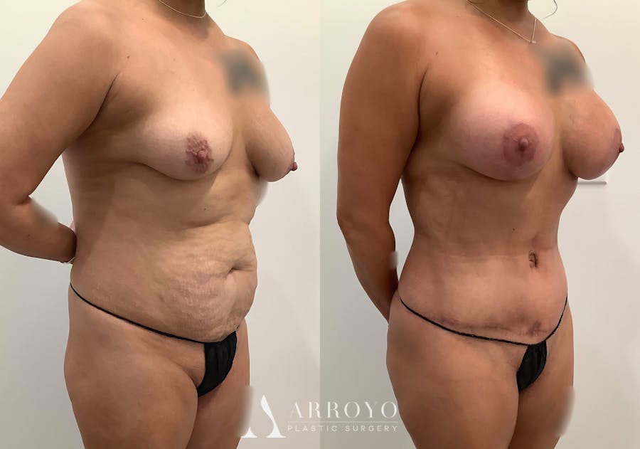 Tummy Tuck Before & After Gallery - Patient 246944 - Image 2