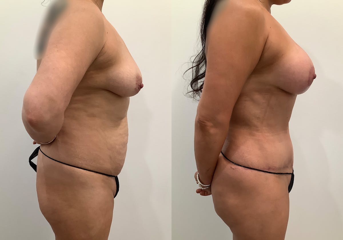 Breast Augmentation with Lift Before & After Gallery - Patient 354953 - Image 3