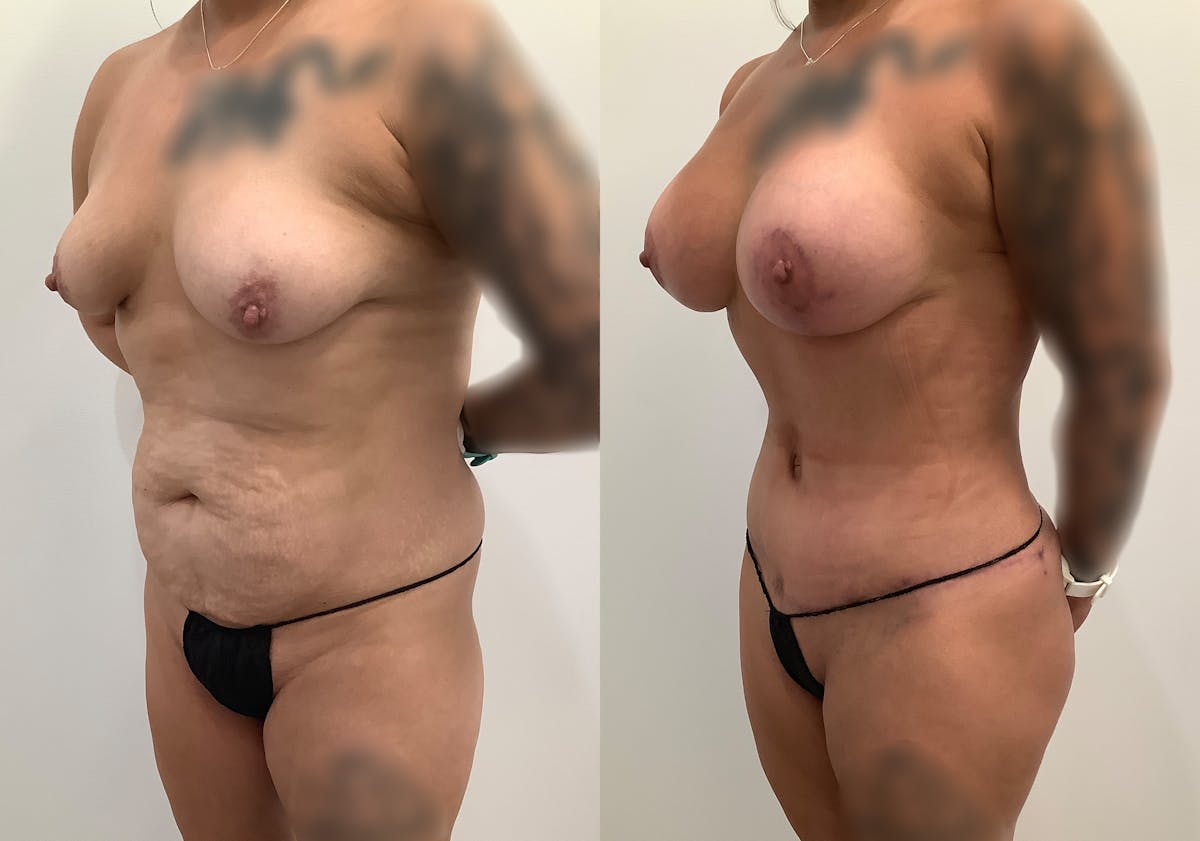 Breast Augmentation with Lift Before & After Gallery - Patient 354953 - Image 4