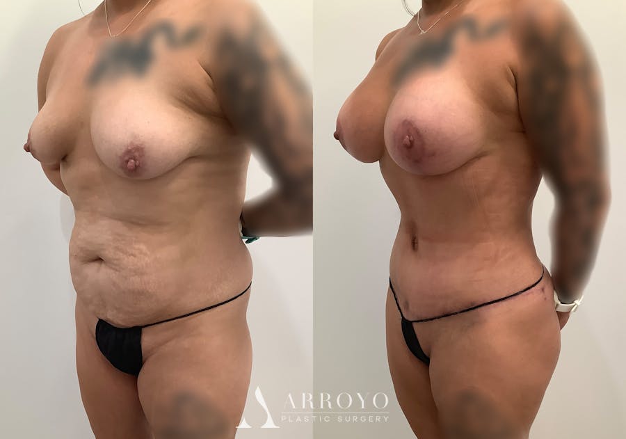 Tummy Tuck Before & After Gallery - Patient 246944 - Image 4