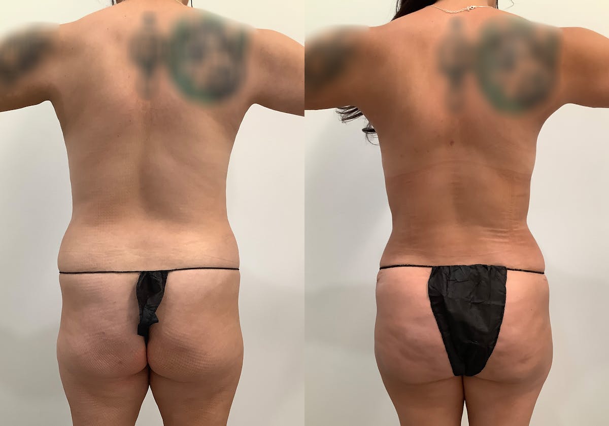 Breast Augmentation with Lift Before & After Gallery - Patient 354953 - Image 5