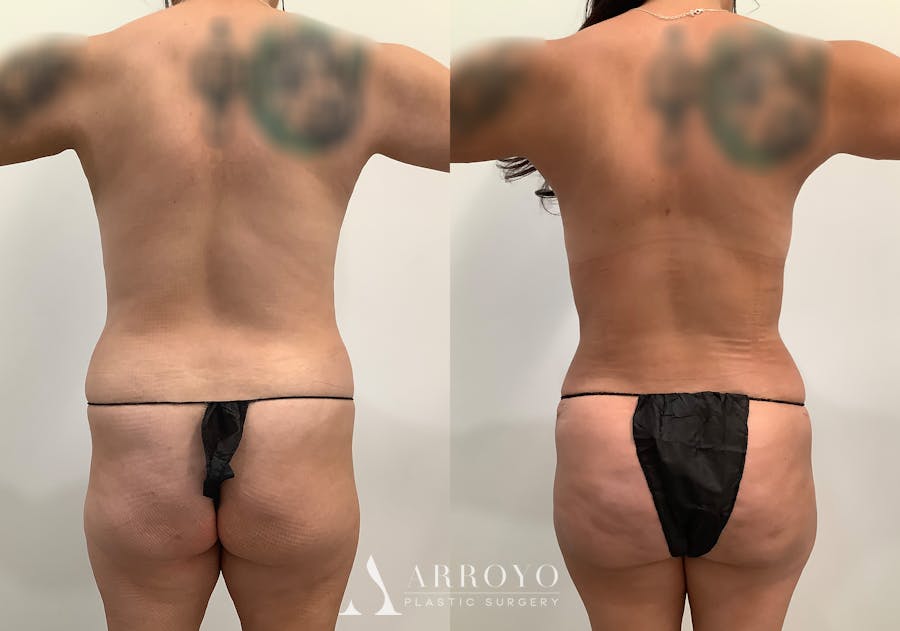 Tummy Tuck Before & After Gallery - Patient 246944 - Image 5