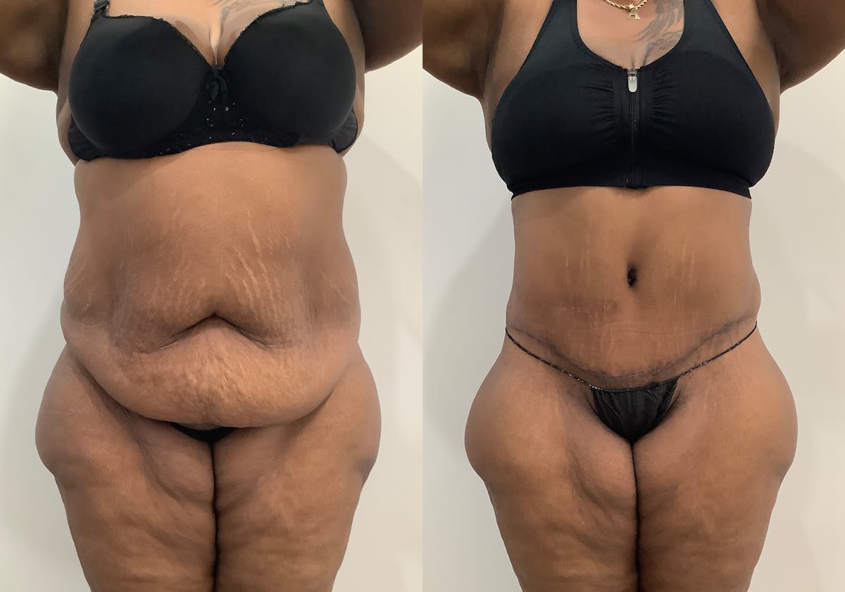 Body Lift Before & After Gallery - Patient 843787 - Image 1