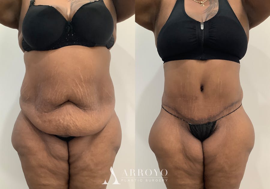 Liposuction Before & After Gallery - Patient 281643 - Image 1