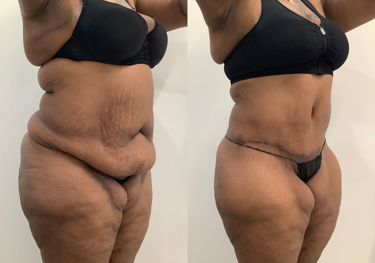 Body Lift Before & After Gallery - Patient 843787 - Image 2