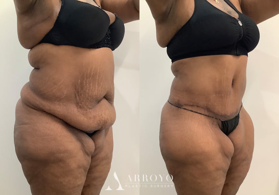 Liposuction Before & After Gallery - Patient 281643 - Image 2