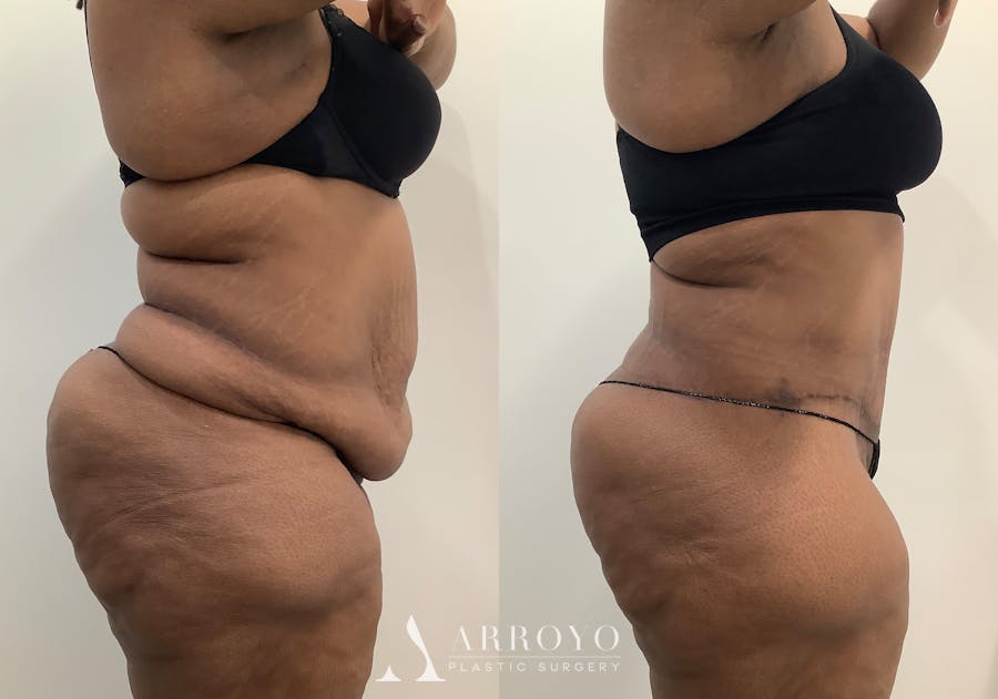 Liposuction Before & After Gallery - Patient 281643 - Image 3