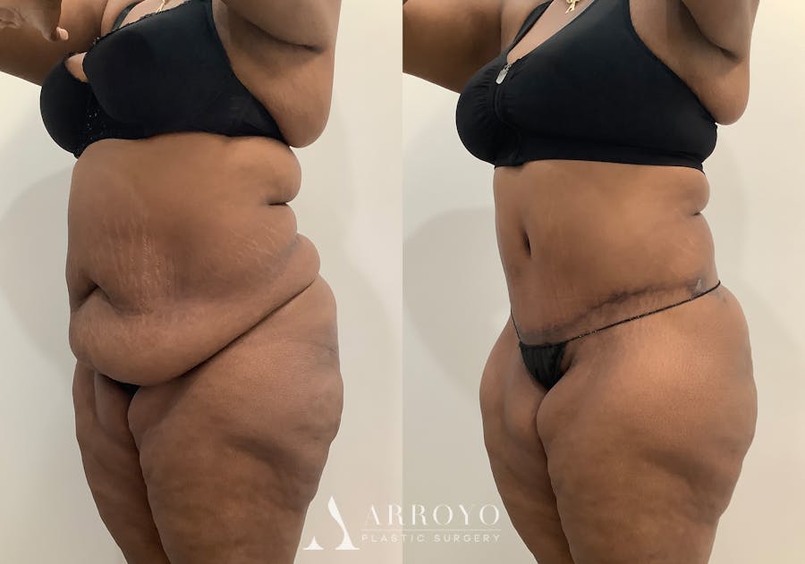 Liposuction Before & After Gallery - Patient 281643 - Image 4