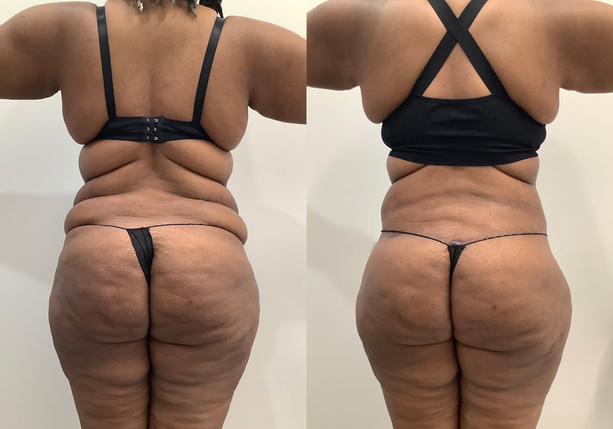 Body Lift Before & After Gallery - Patient 843787 - Image 5