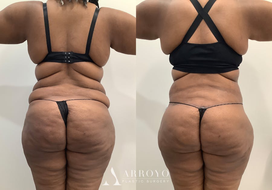 Liposuction Before & After Gallery - Patient 281643 - Image 5