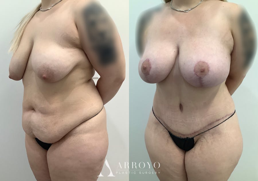 Tummy Tuck Before & After Gallery - Patient 444217 - Image 4