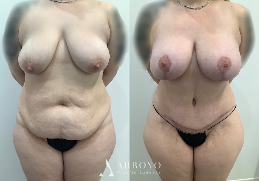 Tummy Tuck Before & After Gallery - Patient 444217 - Image 1