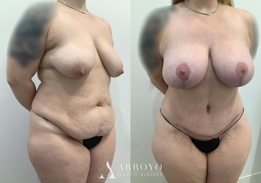 Tummy Tuck Before & After Gallery - Patient 444217 - Image 2