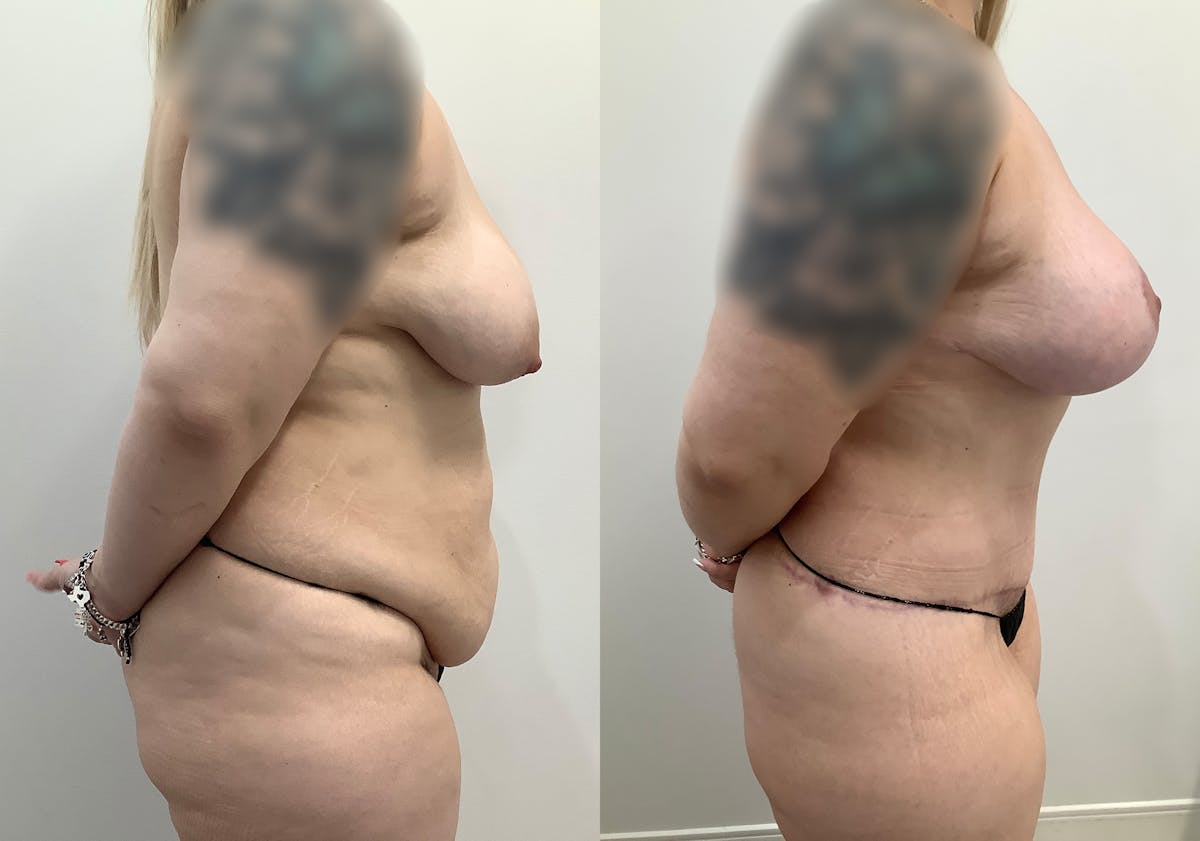 Liposuction Before & After Gallery - Patient 422591 - Image 3