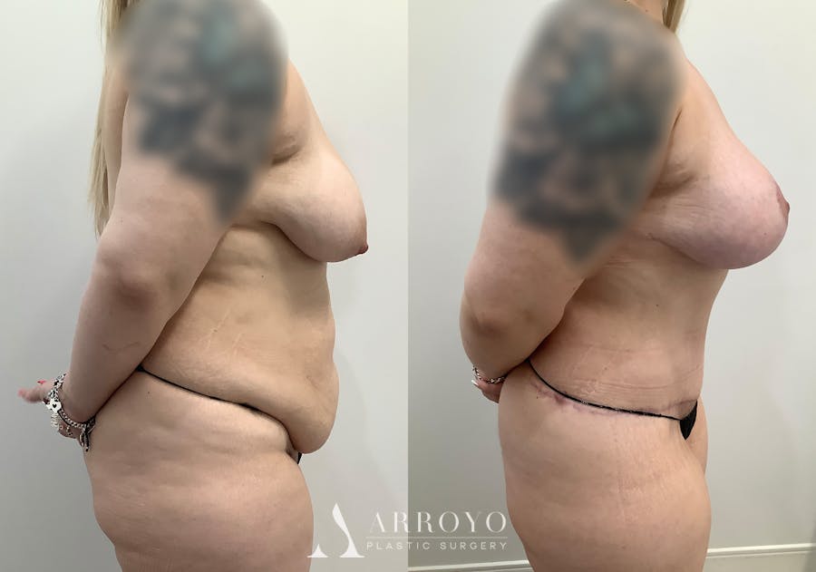 Tummy Tuck Before & After Gallery - Patient 444217 - Image 3