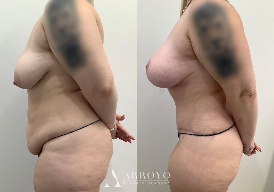 Tummy Tuck Before & After Gallery - Patient 444217 - Image 5