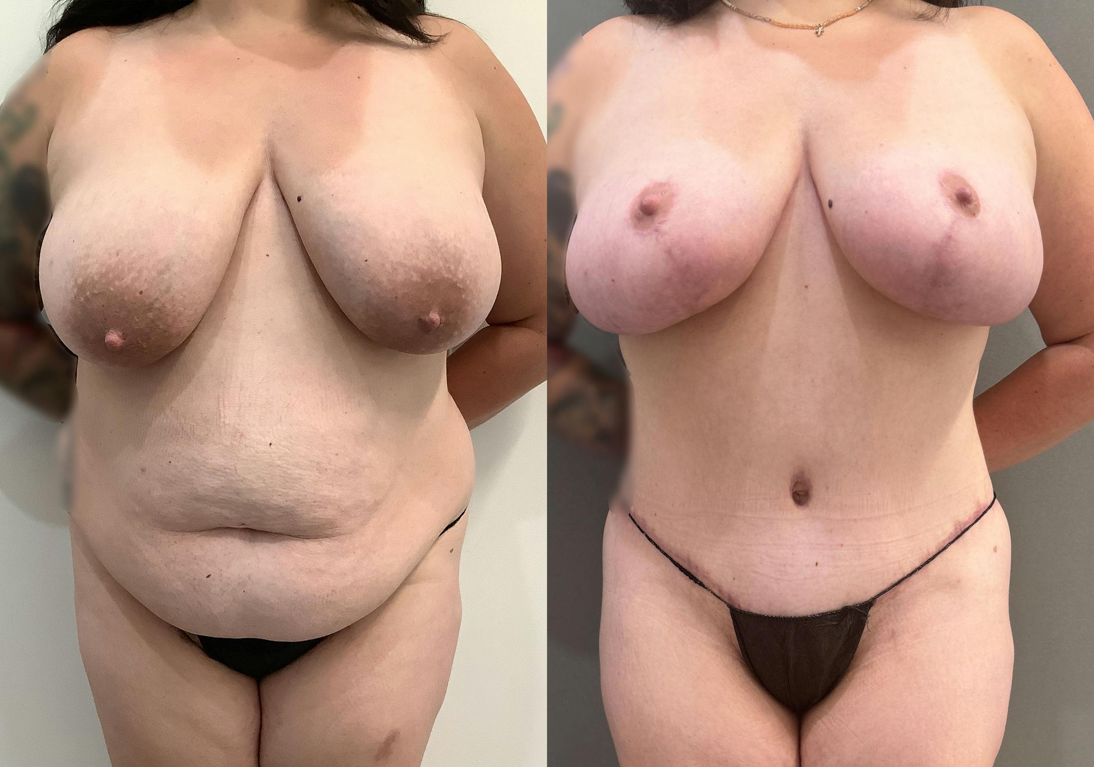 Liposuction Before & After Gallery - Patient 364721 - Image 1